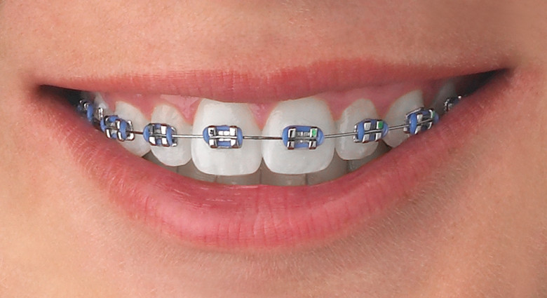¿Qué son los brackets?