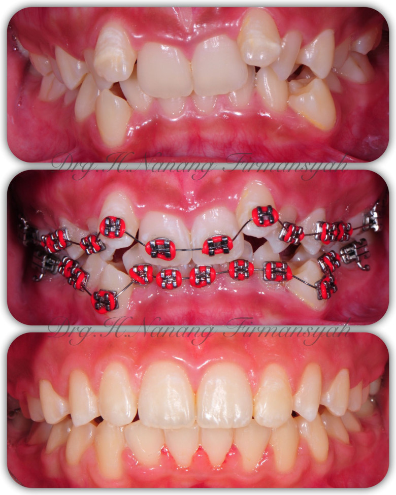 ¿Para qué se usan los brackets?