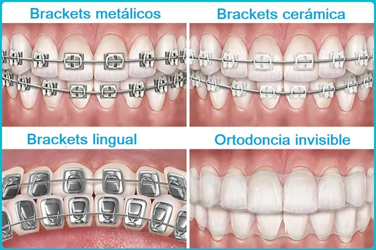 Tipos de brackets disponibles