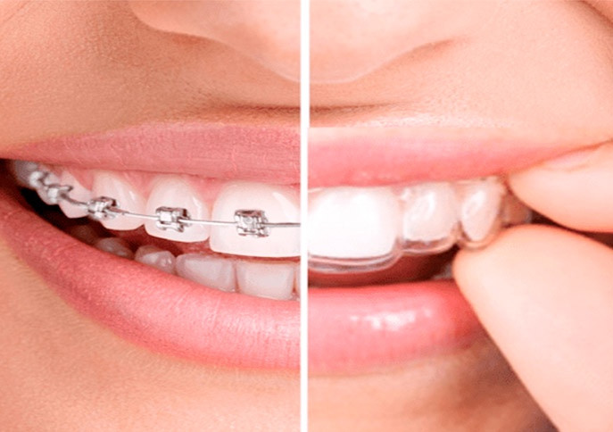 Beneficios de usar brackets