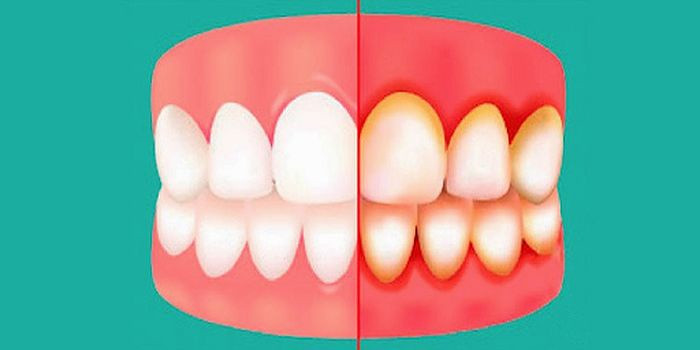 Gingivitis del embarazo