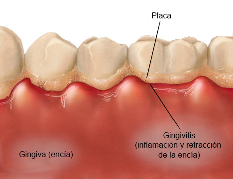 ¿Qué es la gingivitis?