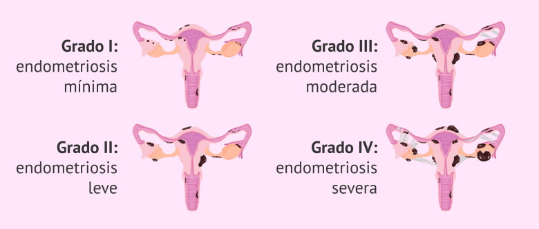 ¿Qué es la endometriosis?