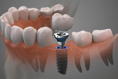 Implantes dentales (Parte 1)