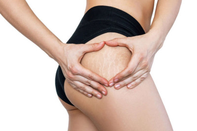 Tratamiento para las estrías