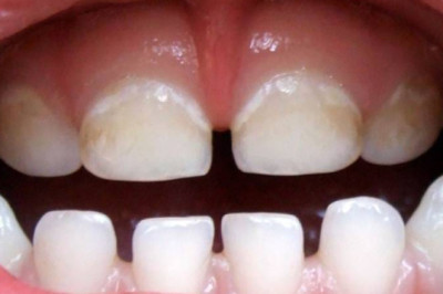 ¿Qué son las caries blancas?