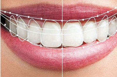 Sonrisas transformadas : El  Arte de las Carillas de Resina