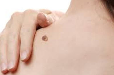 Elimina las Verrugas