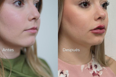 Perfiloplastia  en redux