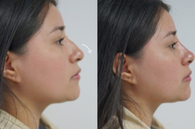 Nariz perfecta / Sin cirugía   (Resultados Naturales y Rápidos)