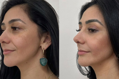 ¡Embellece tu piel sin cirugía y luce radiante! 🌟