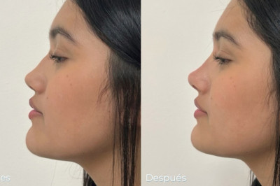 Rinoredux sin cirugía 💚💉