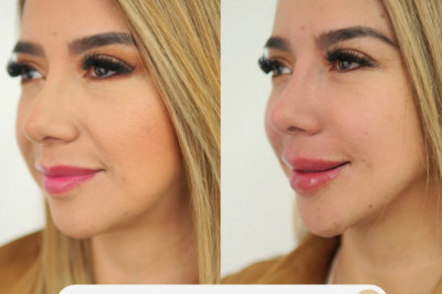 Medicina Estética este 8 de Agosto en Xela