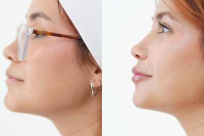 Más volumen en tus labios 👄