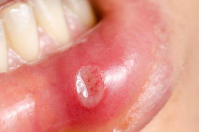 Úlceras bucales: ¿Qué son y cómo tratarlas?