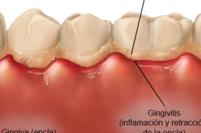 Gingivitis: qué es y cómo prevenirla