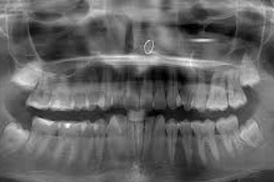 ¿Por qué elegir CRA para tus radiografías dentales?