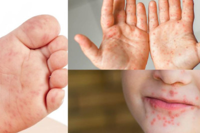 ¡Alerta viral! Brote de manos, pies y boca afecta a niños en Sacatepéquez