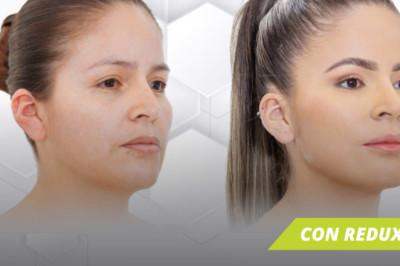 RinoRedux: un cambio sutil que transforma tu rostro 👃✨