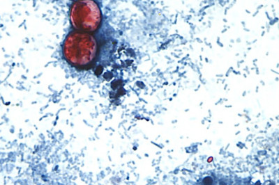 EE. UU. investiga más de 6 mil 700 reportes relacionados con un brote de Cyclospora